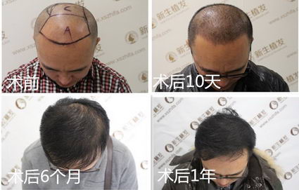 第七屆“關注效果 平安植發(fā)”盛大開啟 南京新生植發(fā)再創(chuàng)零賠付業(yè)界神
