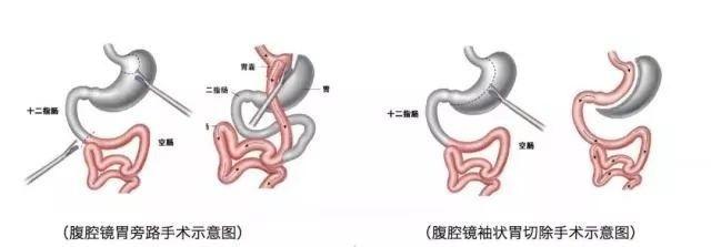 手術(shù)減重靠譜嗎？讓人民醫(yī)院專家告訴你真相